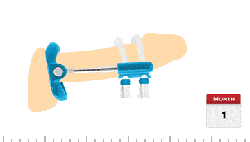 penis extender device