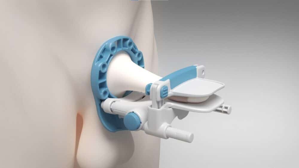 Pens Traction Device In Understanding Penile Traction Device Results: What to Expect and How It ...